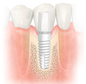Dental implant beneath the gums with a crown attached